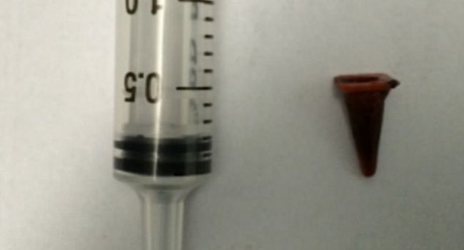 Врачи приняли за рак деталь конструктора, пролежавшую в легких 40 лет