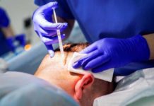 Пересадка волос для мужчин: особенности