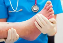 Влажная гангрена: симптомы, диагностика и лечение