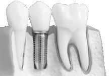 Имплантация зубов: Верните себе здоровую улыбку и уверенность