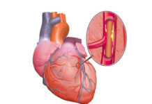 Ишемическая болезнь сердца: причины, симптомы, диагностика и лечение